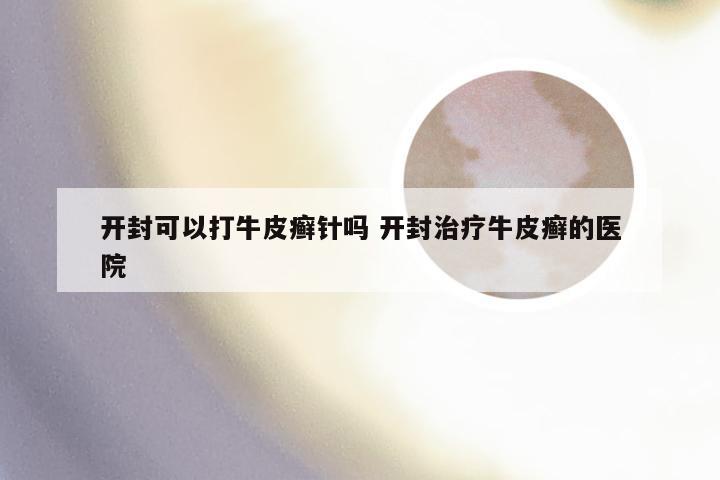 开封可以打牛皮癣针吗 开封治疗牛皮癣的医院