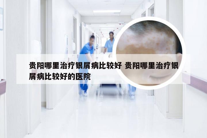贵阳哪里治疗银屑病比较好 贵阳哪里治疗银屑病比较好的医院