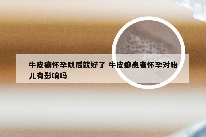 牛皮癣怀孕以后就好了 牛皮癣患者怀孕对胎儿有影响吗