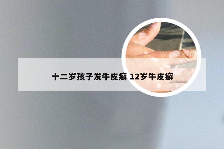 十二岁孩子发牛皮癣 12岁牛皮癣