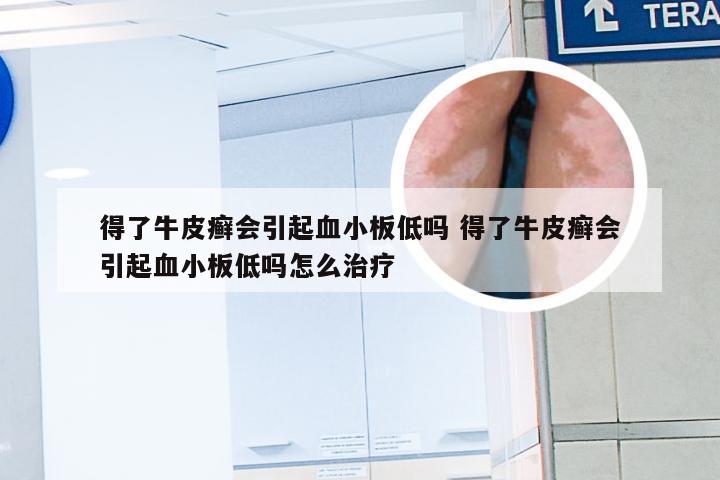 得了牛皮癣会引起血小板低吗 得了牛皮癣会引起血小板低吗怎么治疗