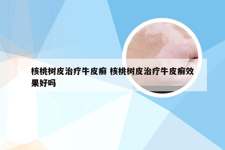 核桃树皮治疗牛皮癣 核桃树皮治疗牛皮癣效果好吗