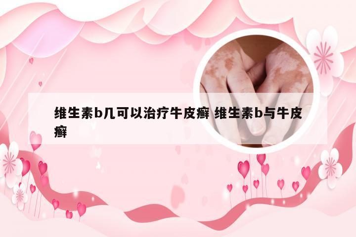维生素b几可以治疗牛皮癣 维生素b与牛皮癣