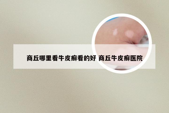 商丘哪里看牛皮癣看的好 商丘牛皮癣医院