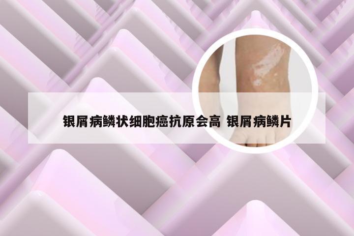 银屑病鳞状细胞癌抗原会高 银屑病鳞片