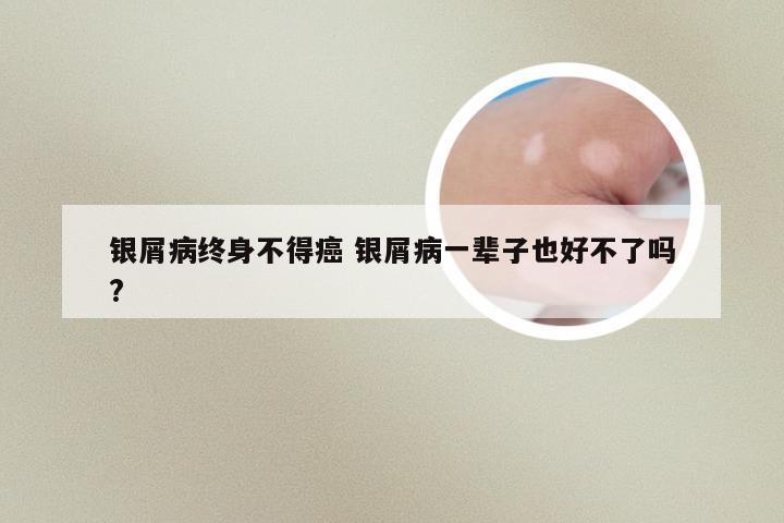 银屑病终身不得癌 银屑病一辈子也好不了吗?