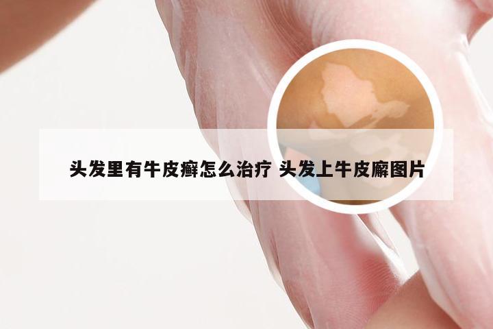 头发里有牛皮癣怎么治疗 头发上牛皮廨图片