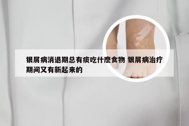 银屑病消退期总有痰吃什麽食物 银屑病治疗期间又有新起来的