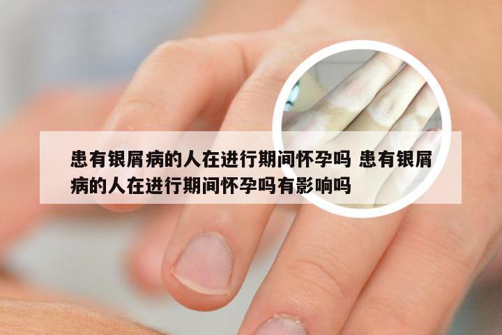 患有银屑病的人在进行期间怀孕吗 患有银屑病的人在进行期间怀孕吗有影响吗