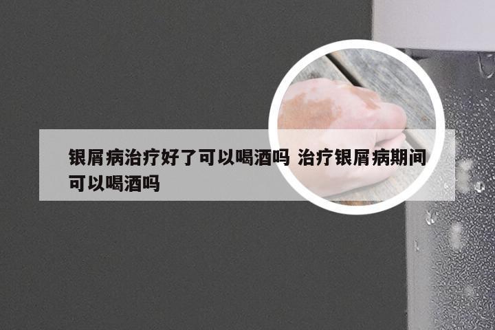 银屑病治疗好了可以喝酒吗 治疗银屑病期间可以喝酒吗