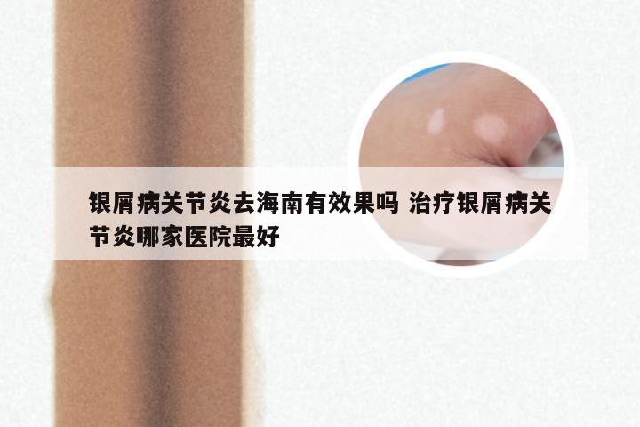 银屑病关节炎去海南有效果吗 治疗银屑病关节炎哪家医院最好