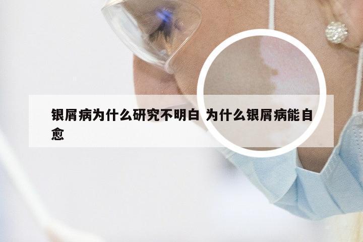 银屑病为什么研究不明白 为什么银屑病能自愈