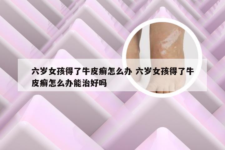 六岁女孩得了牛皮癣怎么办 六岁女孩得了牛皮癣怎么办能治好吗