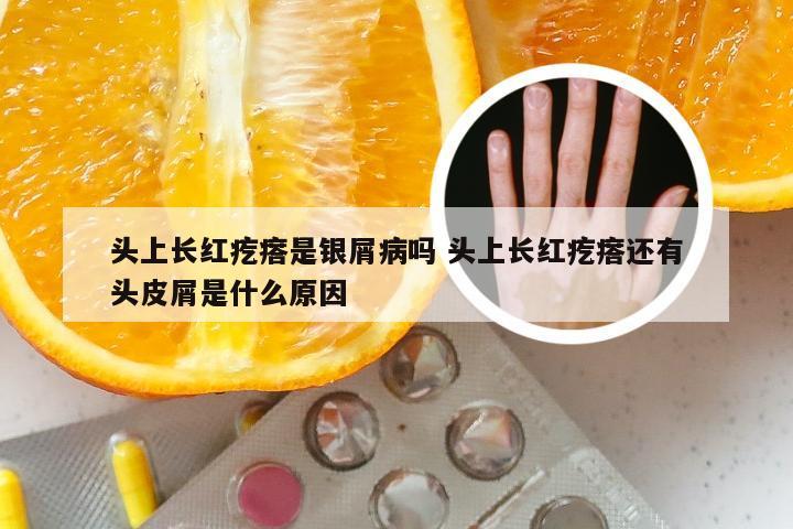 头上长红疙瘩是银屑病吗 头上长红疙瘩还有头皮屑是什么原因