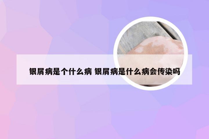 银屑病是个什么病 银屑病是什么病会传染吗