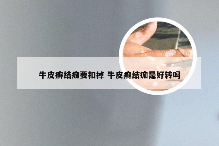 牛皮癣结痂要扣掉 牛皮癣结痂是好转吗
