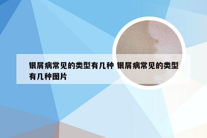 银屑病常见的类型有几种 银屑病常见的类型有几种图片