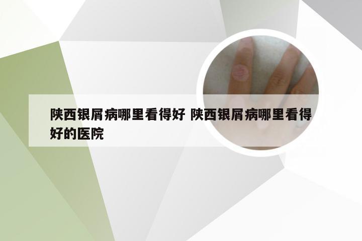 陕西银屑病哪里看得好 陕西银屑病哪里看得好的医院