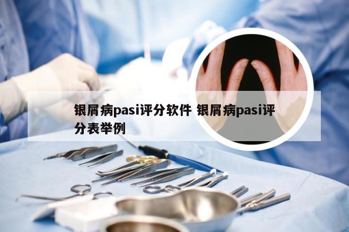 银屑病pasi评分软件 银屑病pasi评分表举例