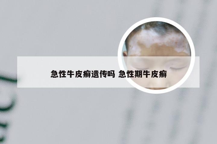 急性牛皮癣遗传吗 急性期牛皮癣