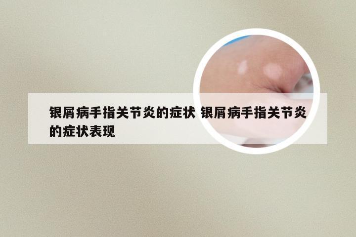 银屑病手指关节炎的症状 银屑病手指关节炎的症状表现