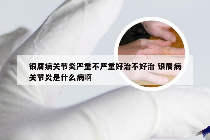 银屑病关节炎严重不严重好治不好治 银屑病关节炎是什么病啊