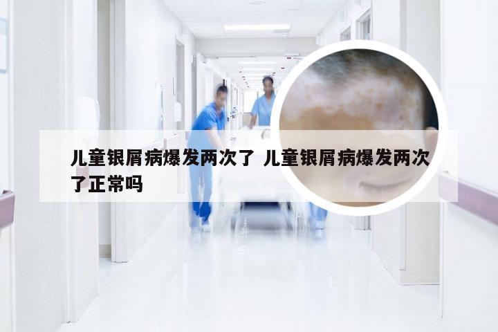 儿童银屑病爆发两次了 儿童银屑病爆发两次了正常吗
