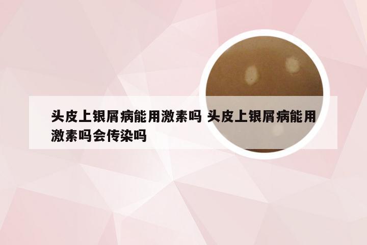 头皮上银屑病能用激素吗 头皮上银屑病能用激素吗会传染吗