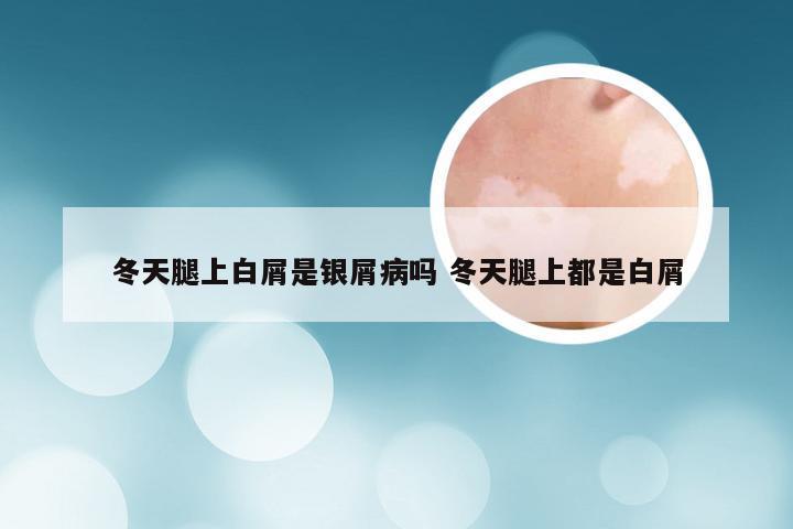 冬天腿上白屑是银屑病吗 冬天腿上都是白屑