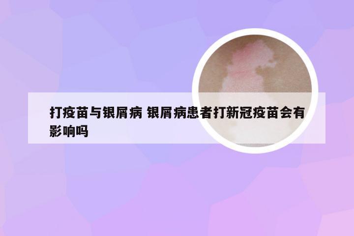 打疫苗与银屑病 银屑病患者打新冠疫苗会有影响吗