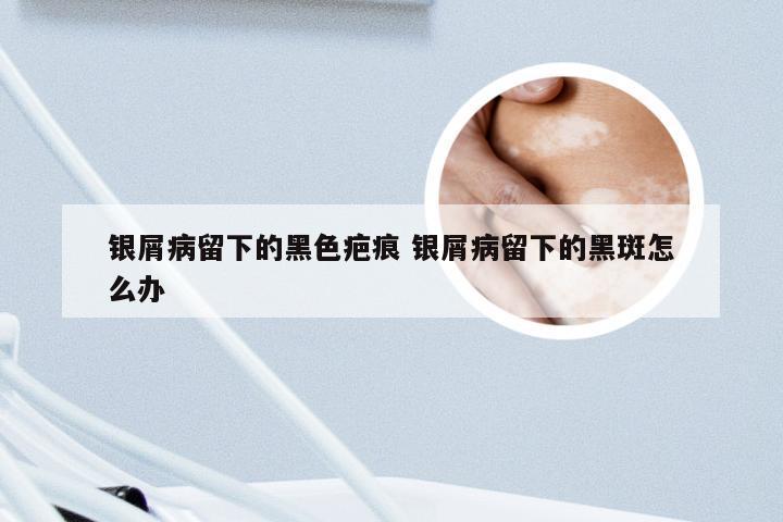 银屑病留下的黑色疤痕 银屑病留下的黑斑怎么办