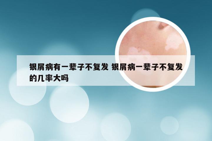 银屑病有一辈子不复发 银屑病一辈子不复发的几率大吗