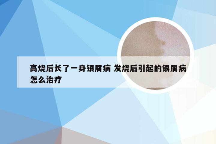 高烧后长了一身银屑病 发烧后引起的银屑病怎么治疗