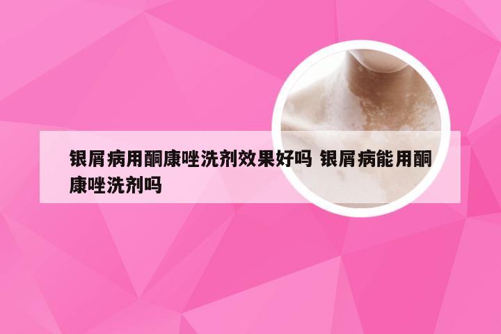 银屑病用酮康唑洗剂效果好吗 银屑病能用酮康唑洗剂吗