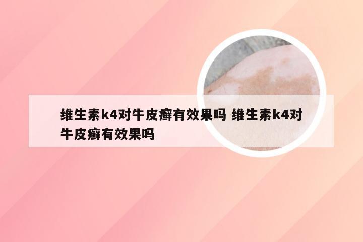 维生素k4对牛皮癣有效果吗 维生素k4对牛皮癣有效果吗