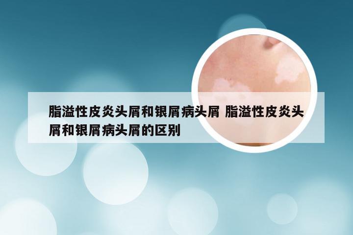 脂溢性皮炎头屑和银屑病头屑 脂溢性皮炎头屑和银屑病头屑的区别