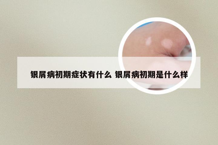银屑病初期症状有什么 银屑病初期是什么样