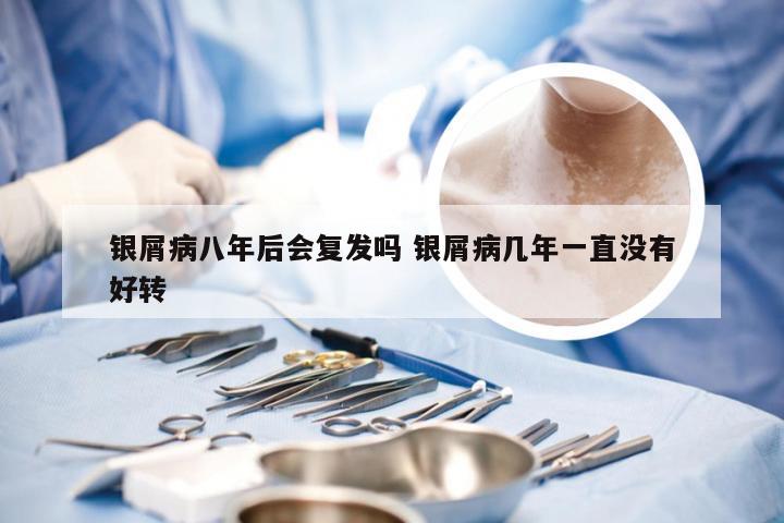 银屑病八年后会复发吗 银屑病几年一直没有好转