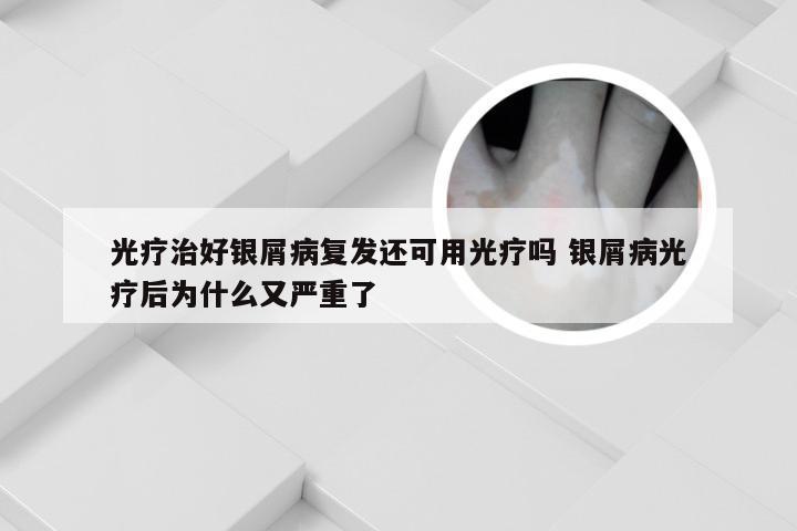 光疗治好银屑病复发还可用光疗吗 银屑病光疗后为什么又严重了