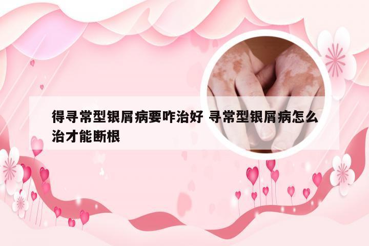 得寻常型银屑病要咋治好 寻常型银屑病怎么治才能断根