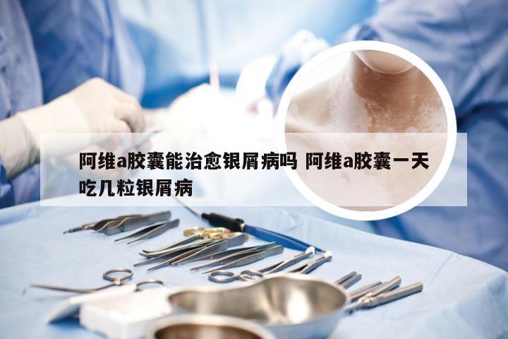 阿维a胶囊能治愈银屑病吗 阿维a胶囊一天吃几粒银屑病