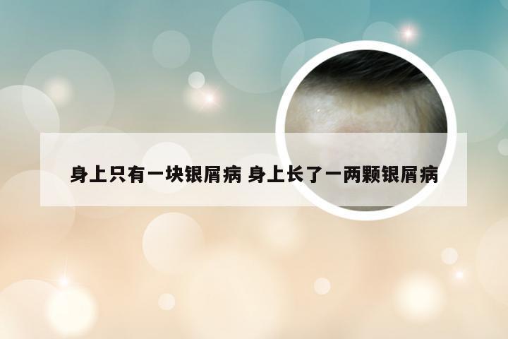 身上只有一块银屑病 身上长了一两颗银屑病