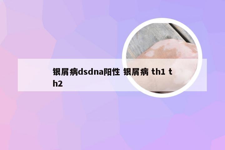 银屑病dsdna阳性 银屑病 th1 th2