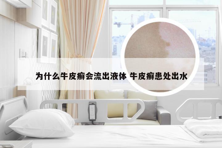 为什么牛皮癣会流出液体 牛皮癣患处出水
