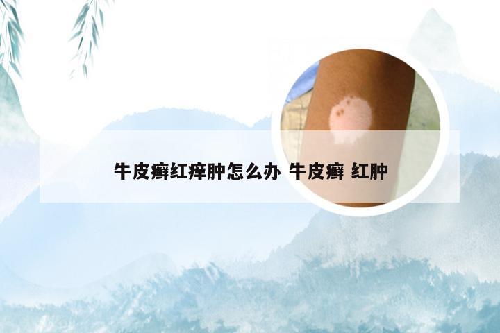牛皮癣红痒肿怎么办 牛皮癣 红肿