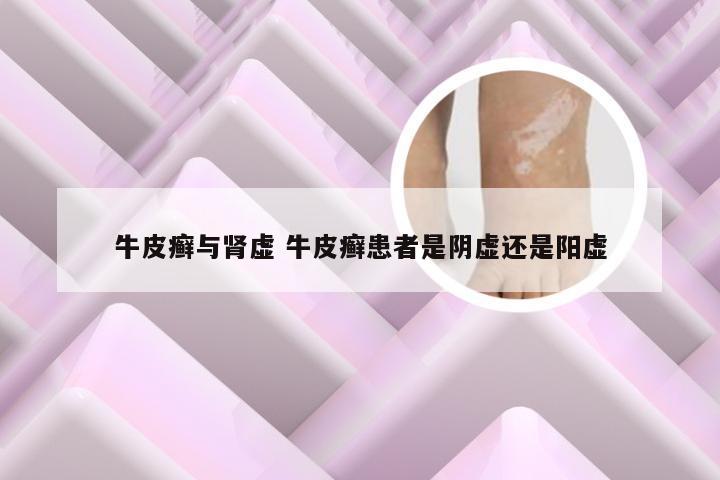 牛皮癣与肾虚 牛皮癣患者是阴虚还是阳虚