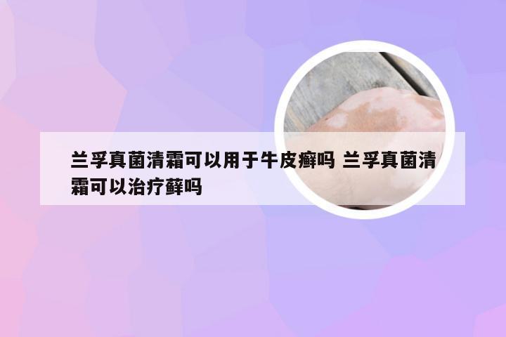 兰孚真菌清霜可以用于牛皮癣吗 兰孚真菌清霜可以治疗藓吗