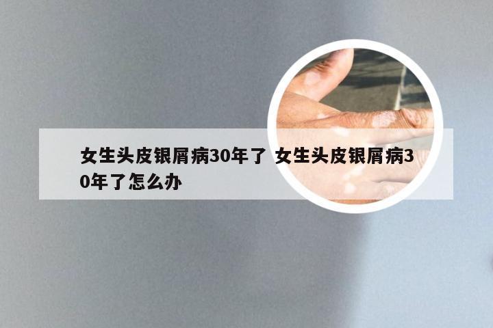女生头皮银屑病30年了 女生头皮银屑病30年了怎么办