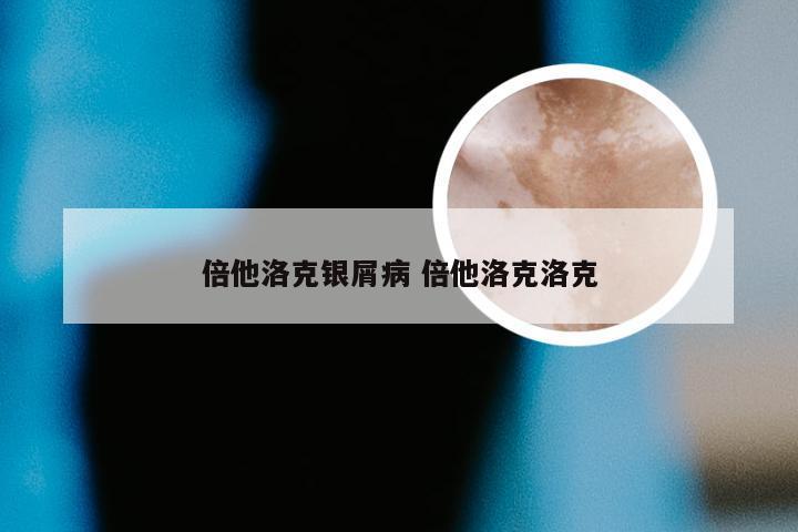 倍他洛克银屑病 倍他洛克洛克