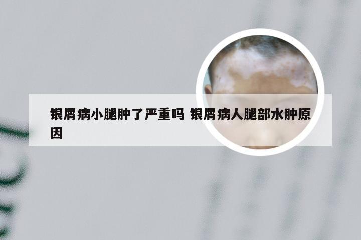 银屑病小腿肿了严重吗 银屑病人腿部水肿原因